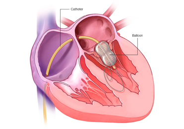 Balloon Valvuloplasty